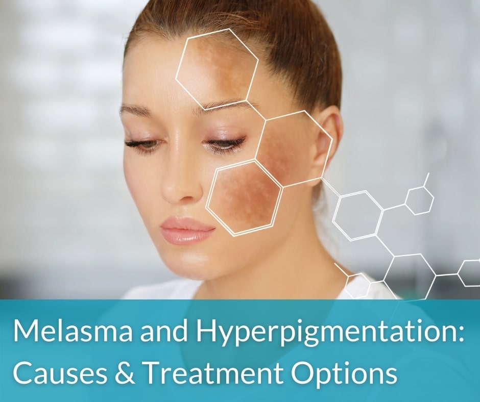melasma and hyperpigmentation