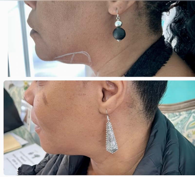 double-chin fat dissolving before and after