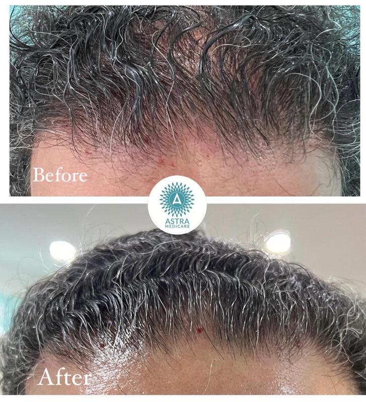 PRP for hair - male front