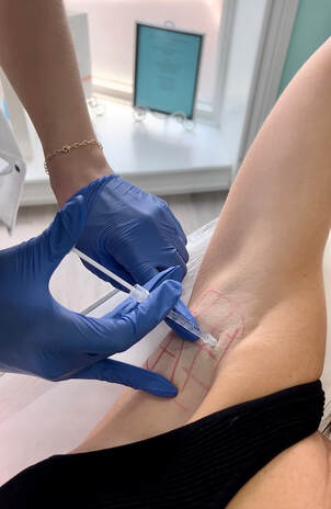 Botox for Excess Sweat Treatment Overview