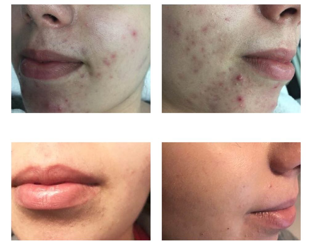 advanced acne treatment before and after