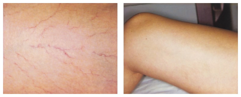 laser spider vein removal before and after
