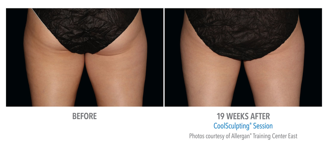 coolsculpting buttocks 19 weeks 